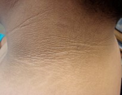 Psoriasis
