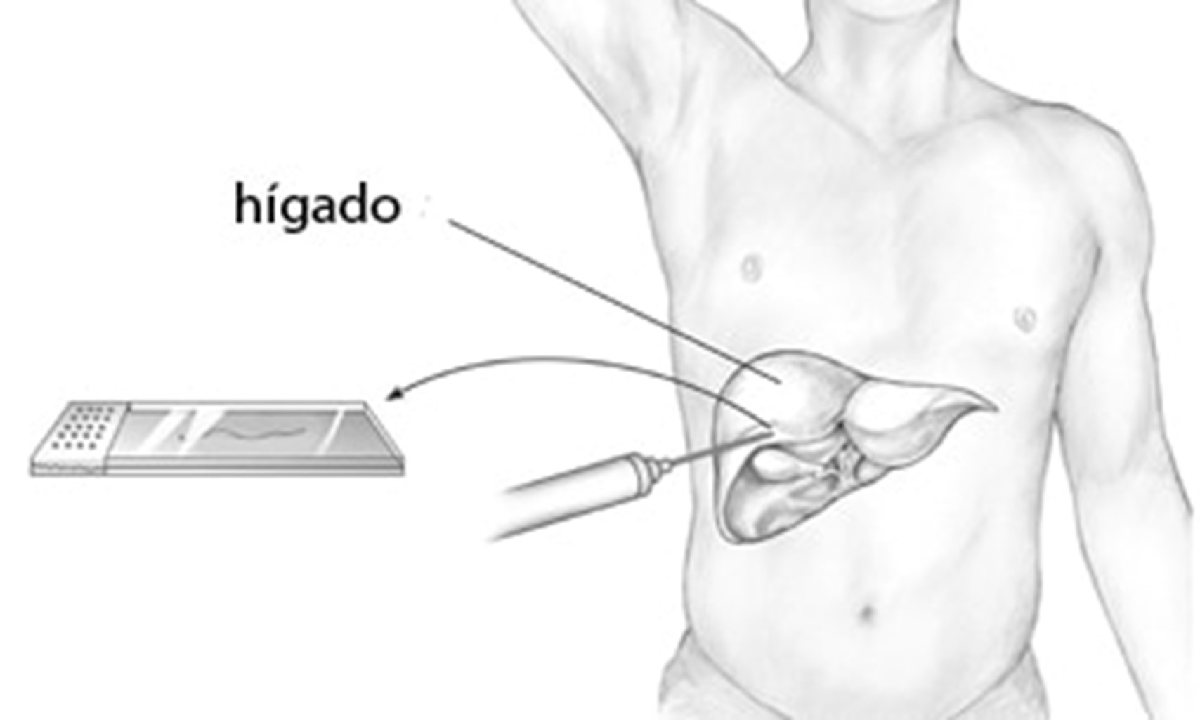 Biopsia del hígado